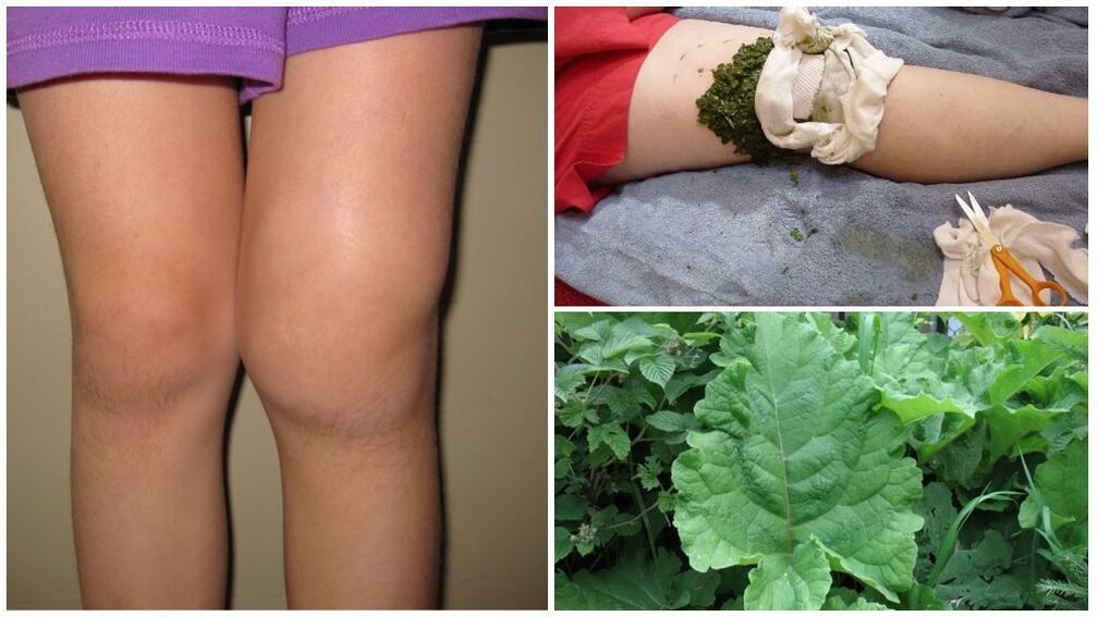Compressing the knee with burdock - a folk method for treating gonarthrosis