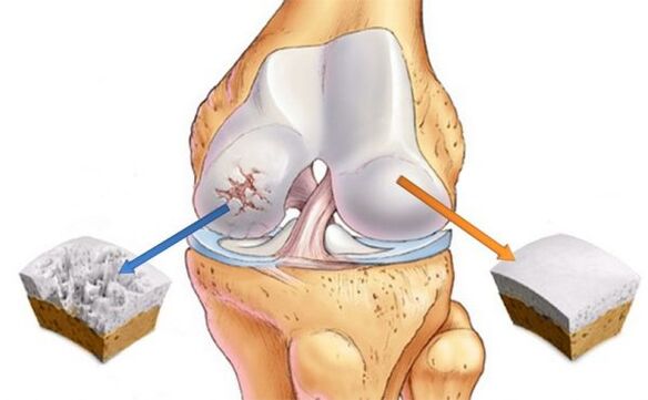 Osteoarthritis of the knee joint (left) and normal cartilage (right)