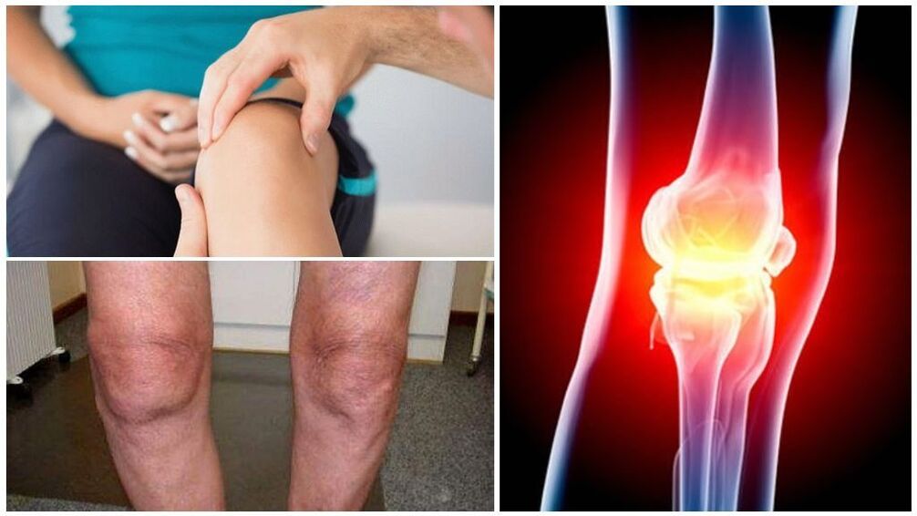 Symptoms of osteoarthritis of the knee joint