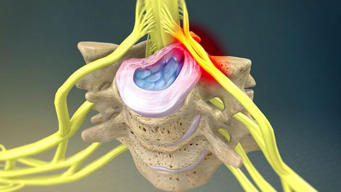 A herniated disc causes neck pain