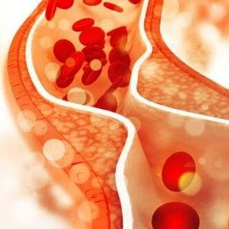 The deposition of cholesterol on the inner walls of blood vessels leads to pain in the neck area